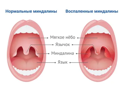 Ангина картинки