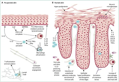 Inverse psoriasis: the diagnostic value of dermatoscopic assessment and the  experience of treatment with a combination topical agent (a clinical  series) - Khlebnikova - Almanac of Clinical Medicine картинки