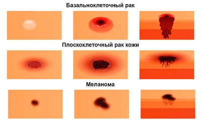 Рак кожи: признаки, стадии, диагностика и лечение. Онкология картинки