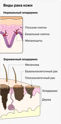 Как выглядит рак кожи и как его лечат картинки