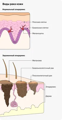 Как выглядит рак кожи и как его лечат картинки