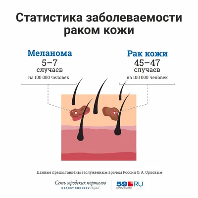 Как отличить рака кожи от меланомы — фото с примерами и рекомендации  онколога - 15 февраля 2019 - ufa1.ru картинки