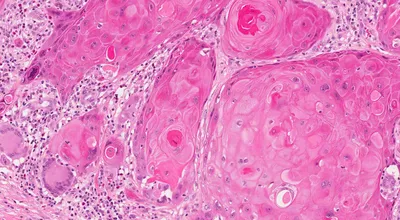 Плоскоклеточный рак кожи | MyPathologyReport.ca картинки