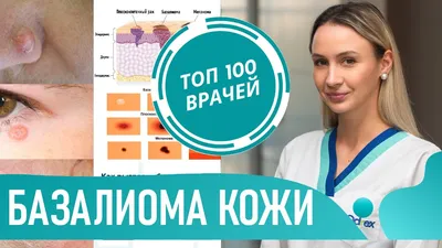 Как выглядит БАЗАЛИОМА (фото 1-7). Базальноклеточный рак кожи.  Базальноклеточная карцинома - YouTube картинки