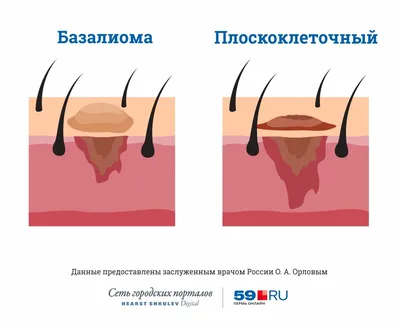 Как отличить рака кожи от меланомы — фото с примерами и рекомендации  онколога - 15 февраля 2019 - ufa1.ru картинки