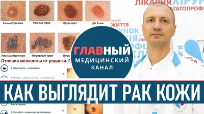 Как выглядит РАК КОЖИ (фото 1-8). Меланома, базалиома и плоскоклеточный рак  кожи - YouTube картинки