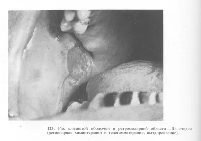 Плоскоклеточный рак полости рта | MyPathologyReport.ca картинки