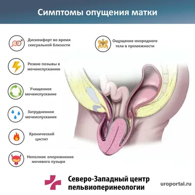 Опущение и выпадение матки: симптомы, причины, диагностика. картинки