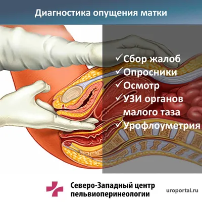 Опущение и выпадение матки: симптомы, причины, диагностика. картинки