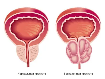 Лечение простатита у мужчин: симптомы, диагностика, цены на лечение  воспаленияе предстательной железы в Москве - клиника IMMA картинки