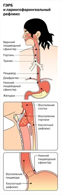 Горло будто сжимают изнутри»: как операция на желудке помогла мне  справиться с удушьем картинки