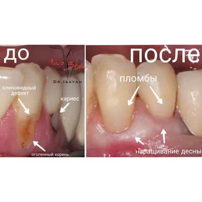 Что будет, если на оголенную шейку зуба просто ставить пломбу? - PerioStom картинки