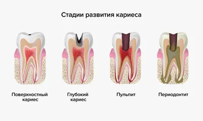 Кариес картинки