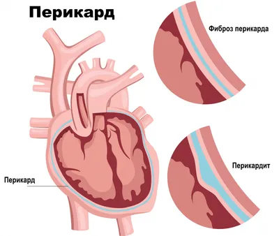 Перикардит - причины появления, симптомы заболевания, диагностика и способы  лечения картинки