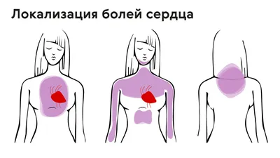 Боль в области сердца: симптомы, признаки, как понять, виды боли в сердце картинки