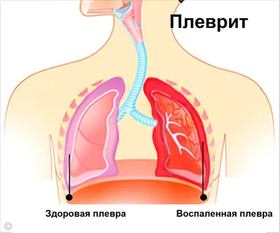 Боль при кашле - причины появления, при каких заболеваниях возникает,  диагностика и способы лечения картинки