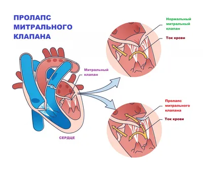 Пролапс митрального клапана - причины появления, симптомы заболевания,  диагностика и способы лечения картинки