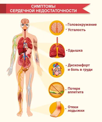 Сердечная недостаточность - симптомы, что это такое, как понять что она у  тебя, признаки картинки