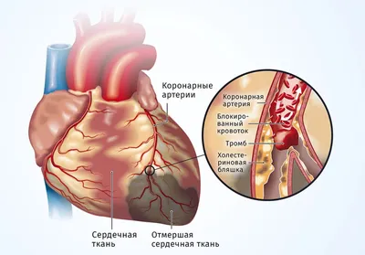 Как лечить ишемическую болезнь картинки