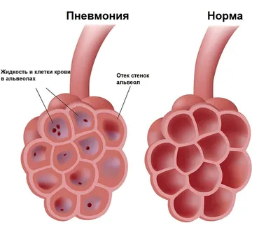 Боль при кашле - причины появления, при каких заболеваниях возникает,  диагностика и способы лечения картинки