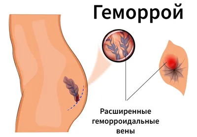 Геморрой у женщин: причины, симптомы, признаки, что делать, как избавиться,  лечение картинки