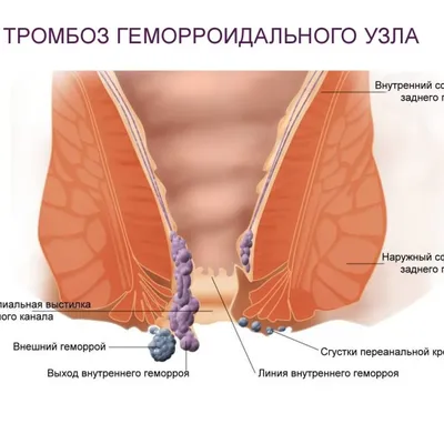 Тромбэктомия геморроидального узла в Москве в \ картинки