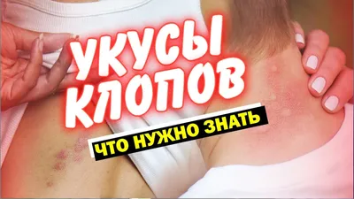 Как выглядят и чем опасны укусы клопов для ребенка картинки