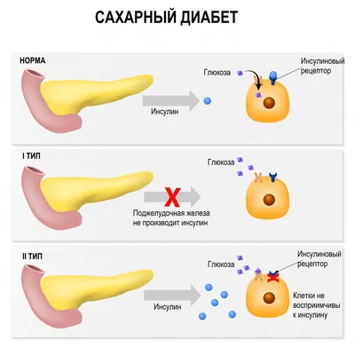 Сахарный диабет (Diabetes, Diabetes mellitus) - причины появления, симптомы  заболевания, диагностика и способы лечения картинки