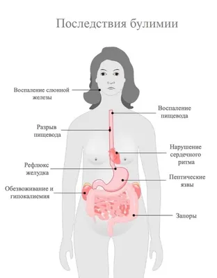 Последствия булимии для организма — как проявляется и чем опасно пищевое  расстройство булимия картинки