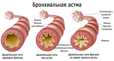 Бронхиальная астма лечить в Житомире - клиника \ картинки