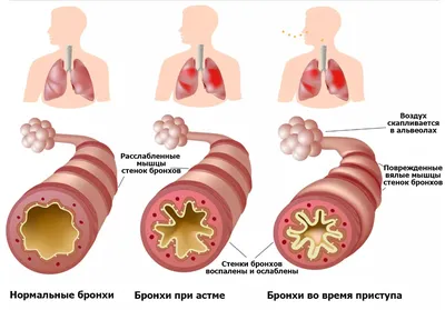 Бронхиальная астма - признаки, симптомы, диагностика картинки