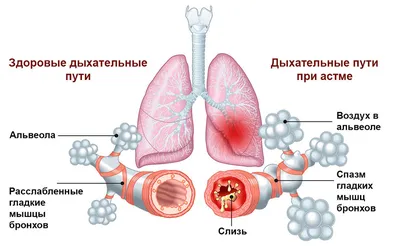 Приступ астмы - механизм развития, симптомы проявления, первая помощь и  лечение картинки