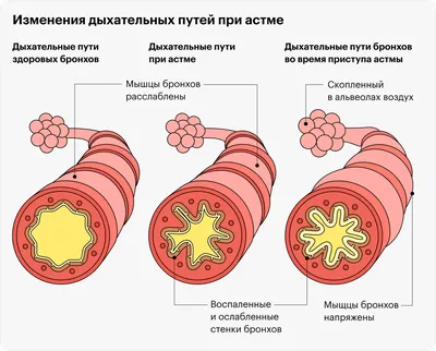 Астма бронхиальная: симптомы, причины и степени тяжести, помогает ли  ингалятор при приступах, берут ли в армию с болезнью картинки