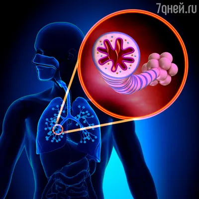 Бронхиальная астма: коварная болезнь с разными симптомами стр.2 - 7Дней.ру картинки
