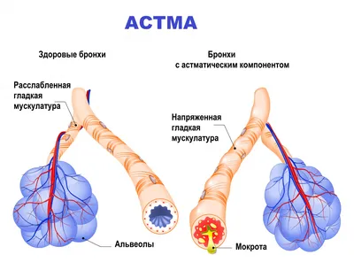 Бронхиальная астма - причины появления, симптомы заболевания, диагностика и  способы лечения картинки